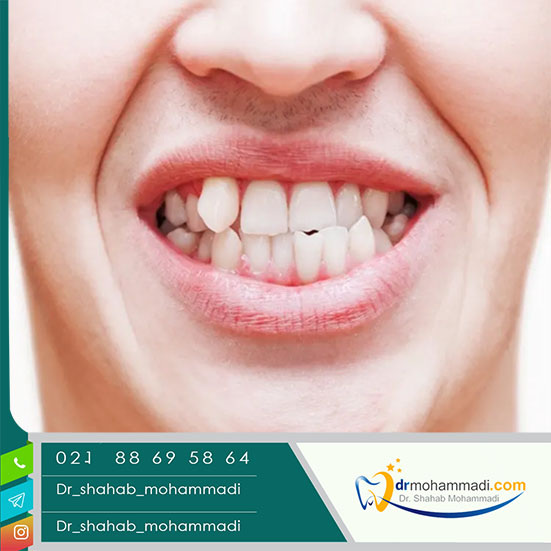 درمان کجی دندان بدون ارتودنسی  آیا لمینت می تواند جایگزین ارتودنسی شود؟ - کلینیک دندانپزشکی دکتر شهاب محمدی